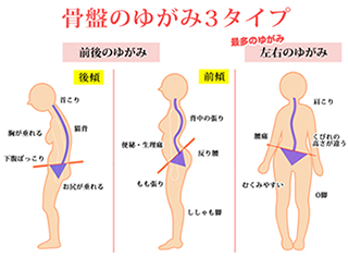骨盤のゆがみ3タイプ