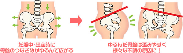 骨盤矯正（出産後）